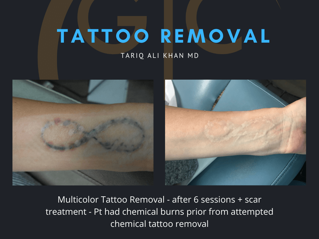 Gentle Care Laser Tustin Before and After picture - Tattoo Removal